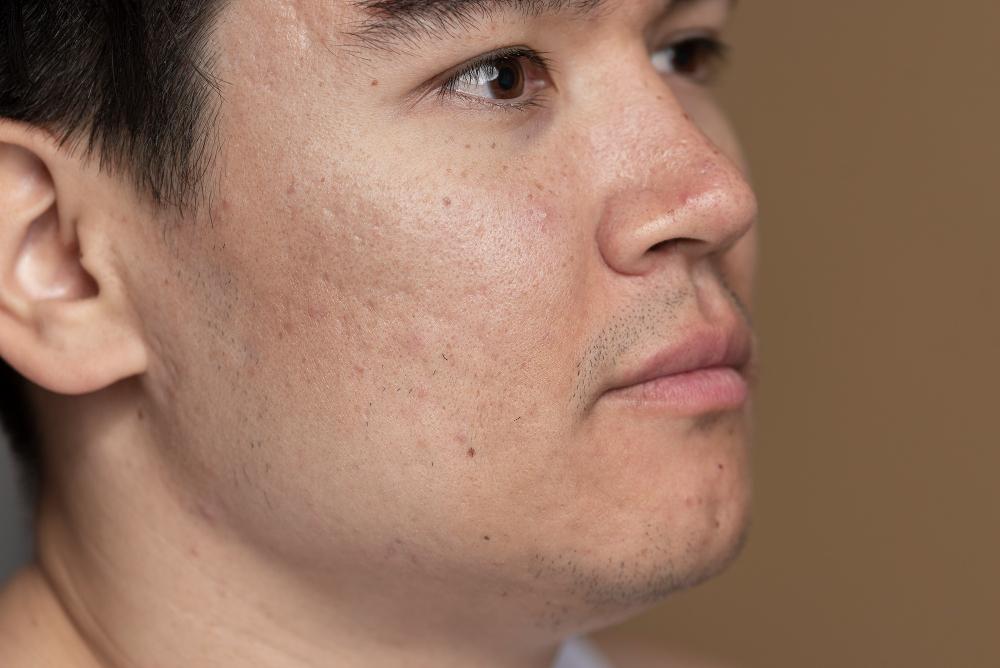 ภาพแสดงสิวบริเวณคาง อาจบ่งชี้ปัญหาทางสุขภาพหรือฮอร์โมนไม่สมดุลย์