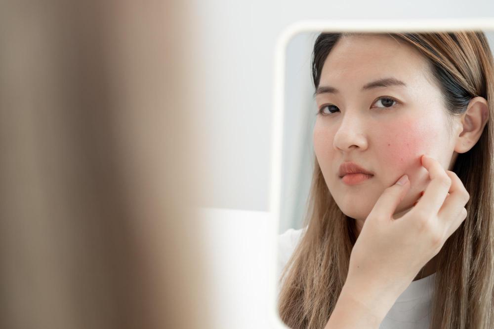 ภาพผู้หญิงมีสิวบนใบหน้าเนื่องจากอาการแพ้ครีมบำรุงผิว