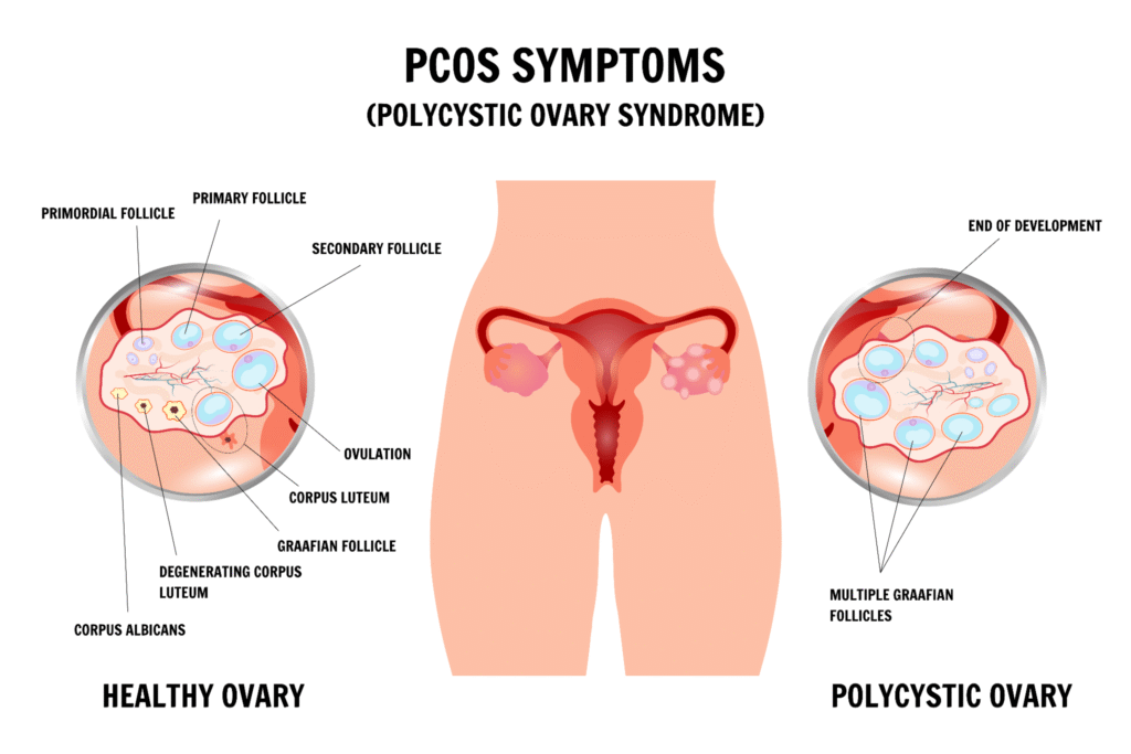 PCOS