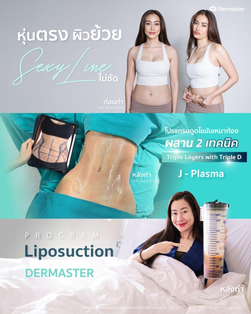 ดูดไขมัน