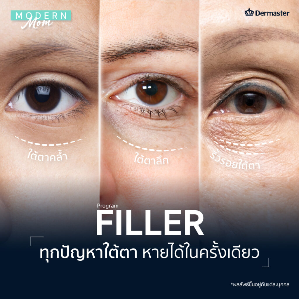 ฉีดฟิลเลอร์ใต้ตา