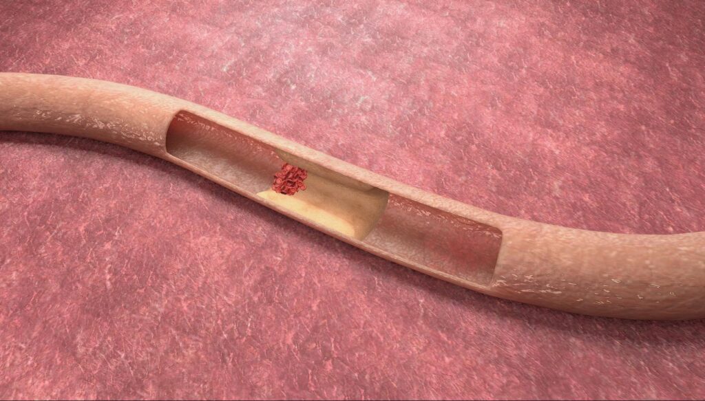 thrombectomy คือ